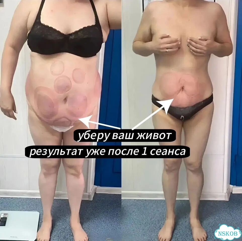 Результат с 1 сеанса от -3 до -24см / Lpg+RET+MC фото 1
