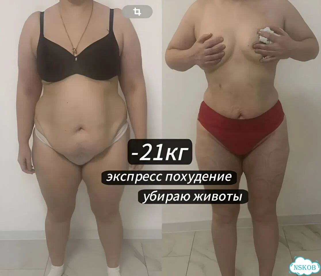 Результат с 1 сеанса от -3 до -24см / Lpg+RET+MC фото 3