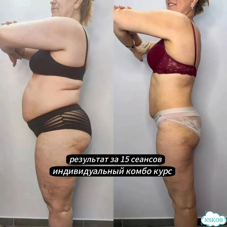 Результат с 1 сеанса от -3 до -24см / Lpg+RET+MC фото 5