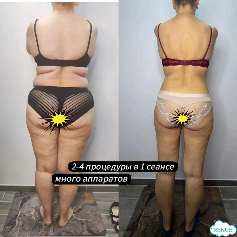 Результат с 1 сеанса от -3 до -24см / Lpg+RET+MC фото 6