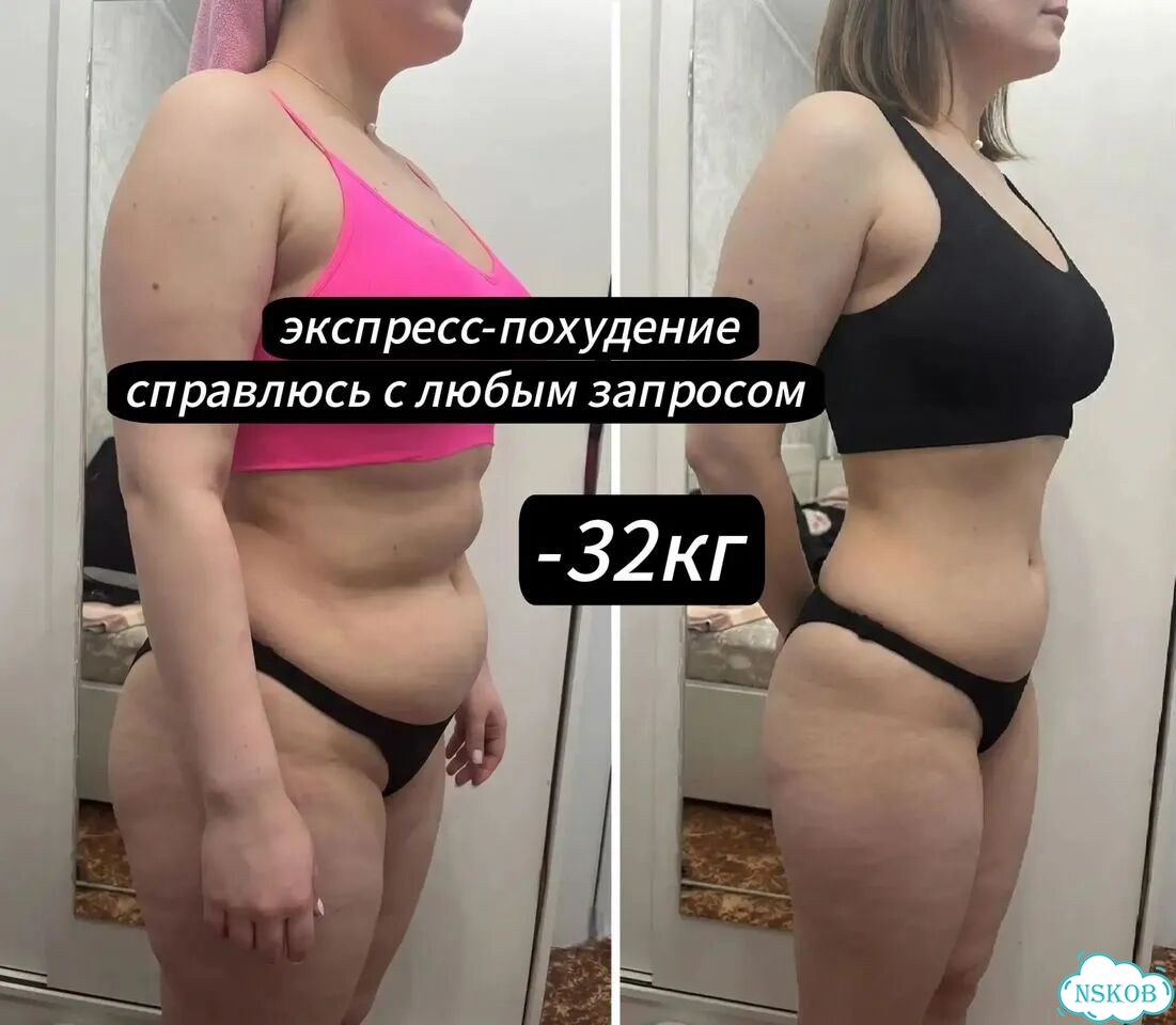 Результат с 1 сеанса от -3 до -24см / Lpg+RET+MC фото 7