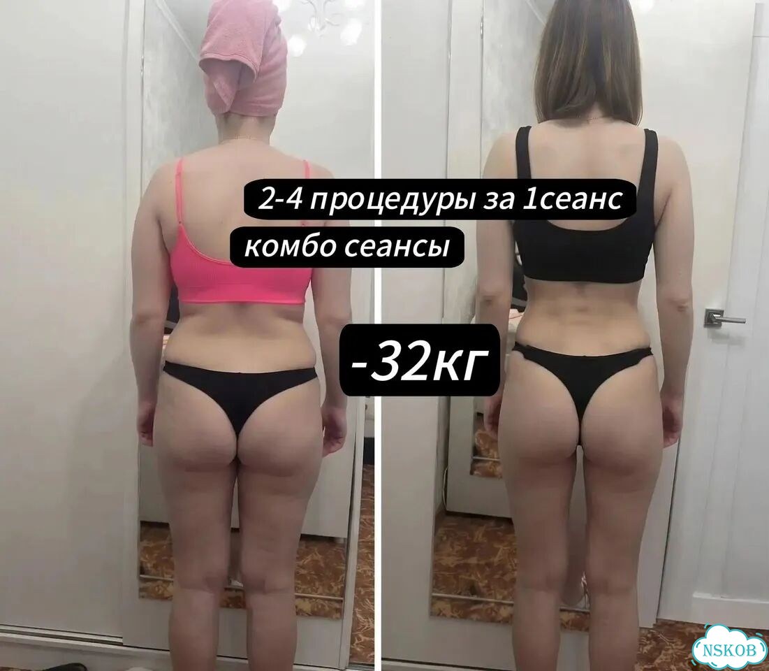 Результат с 1 сеанса от -3 до -24см / Lpg+RET+MC фото 8