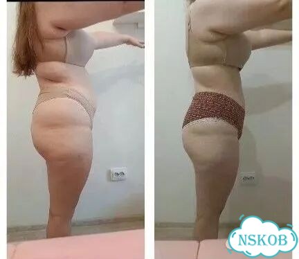 Коррекция фигуры фото 6