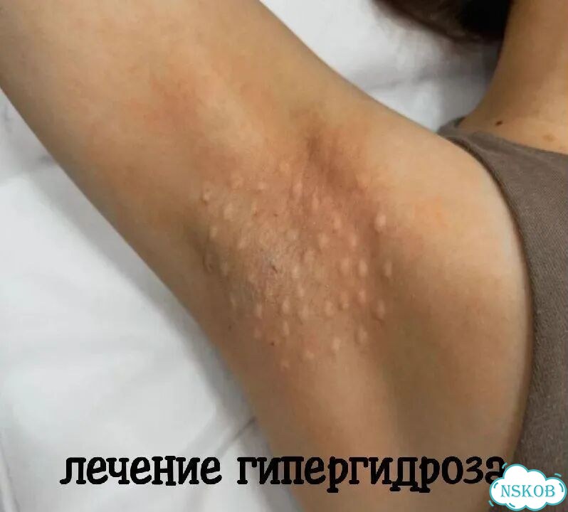 Лечение гипергидроза подмышек фото 1
